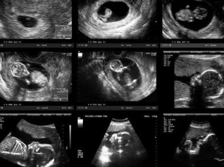 泰国试管婴儿双胞胎费用及与单胎的差价有多大